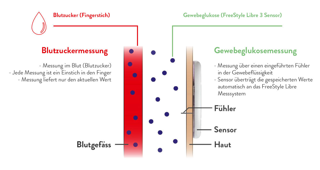 Wo liegt der Unterschied zwischen sensorbasierter kontinuierlicher Glukosemessung und Blutzuckermessung?